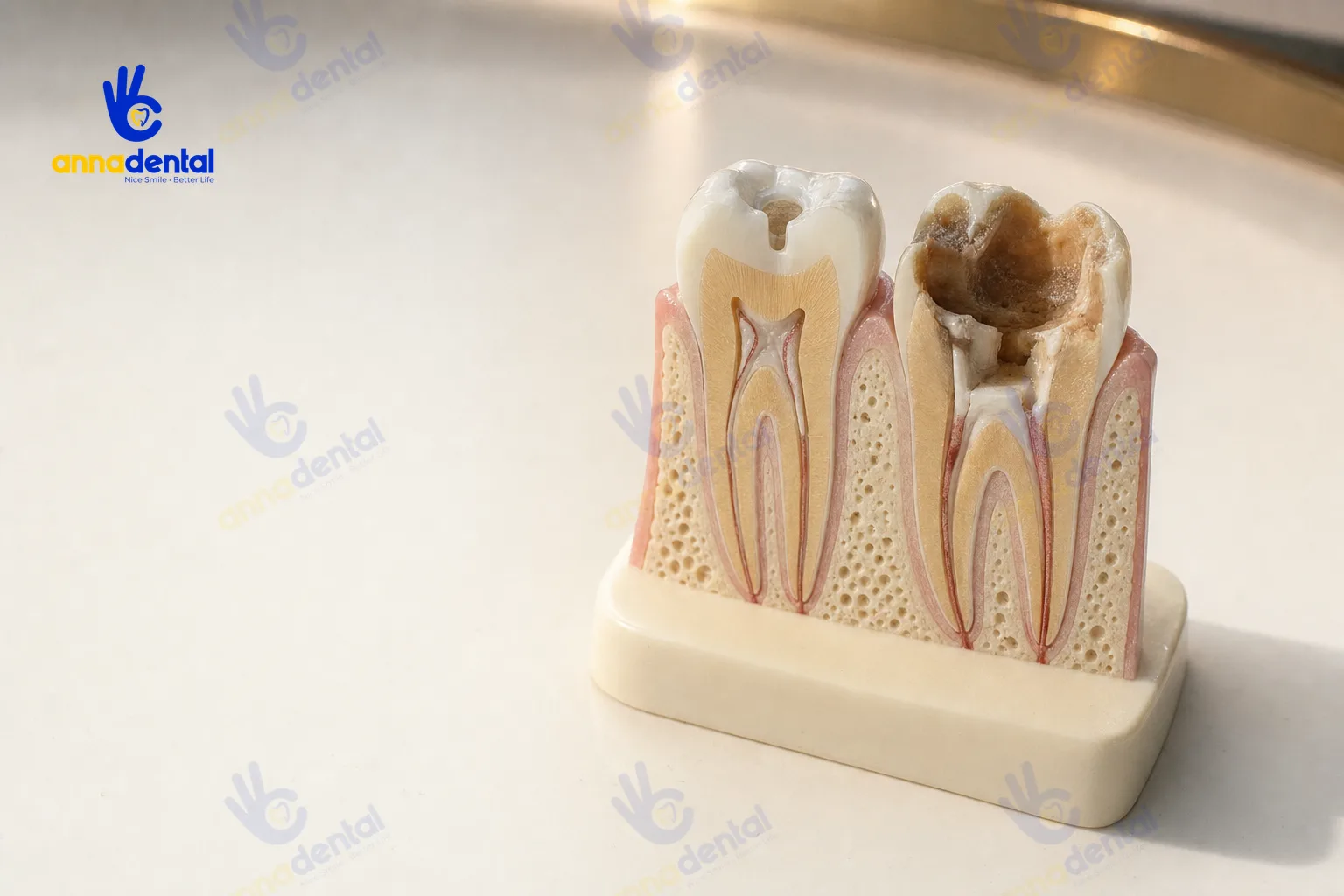Mô hình so sánh răng cửa và răng hàm sau khi lấy tủy