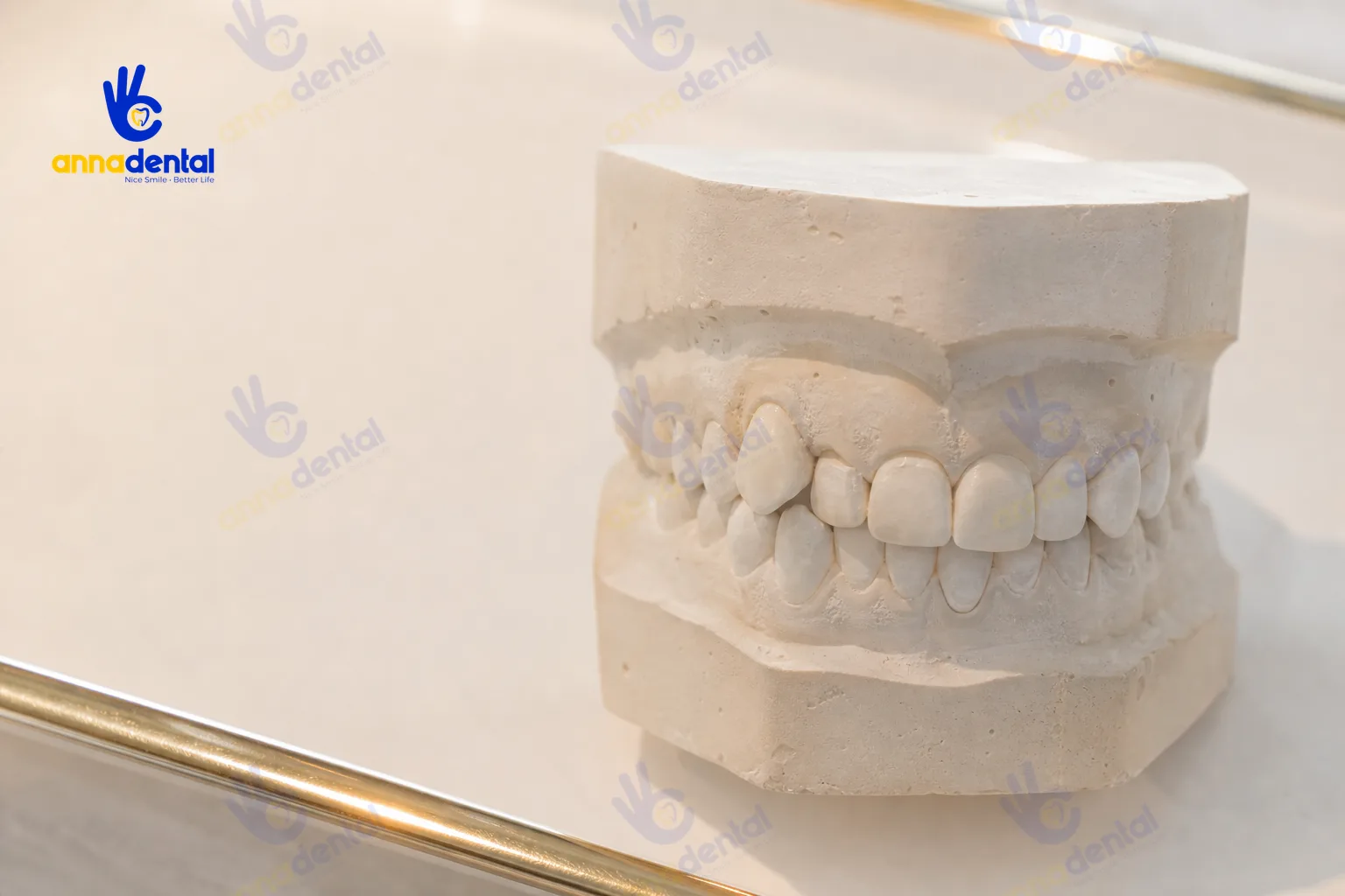 Hình cận cảnh răng khểnh trên mẫu hàm thật trong phòng khám