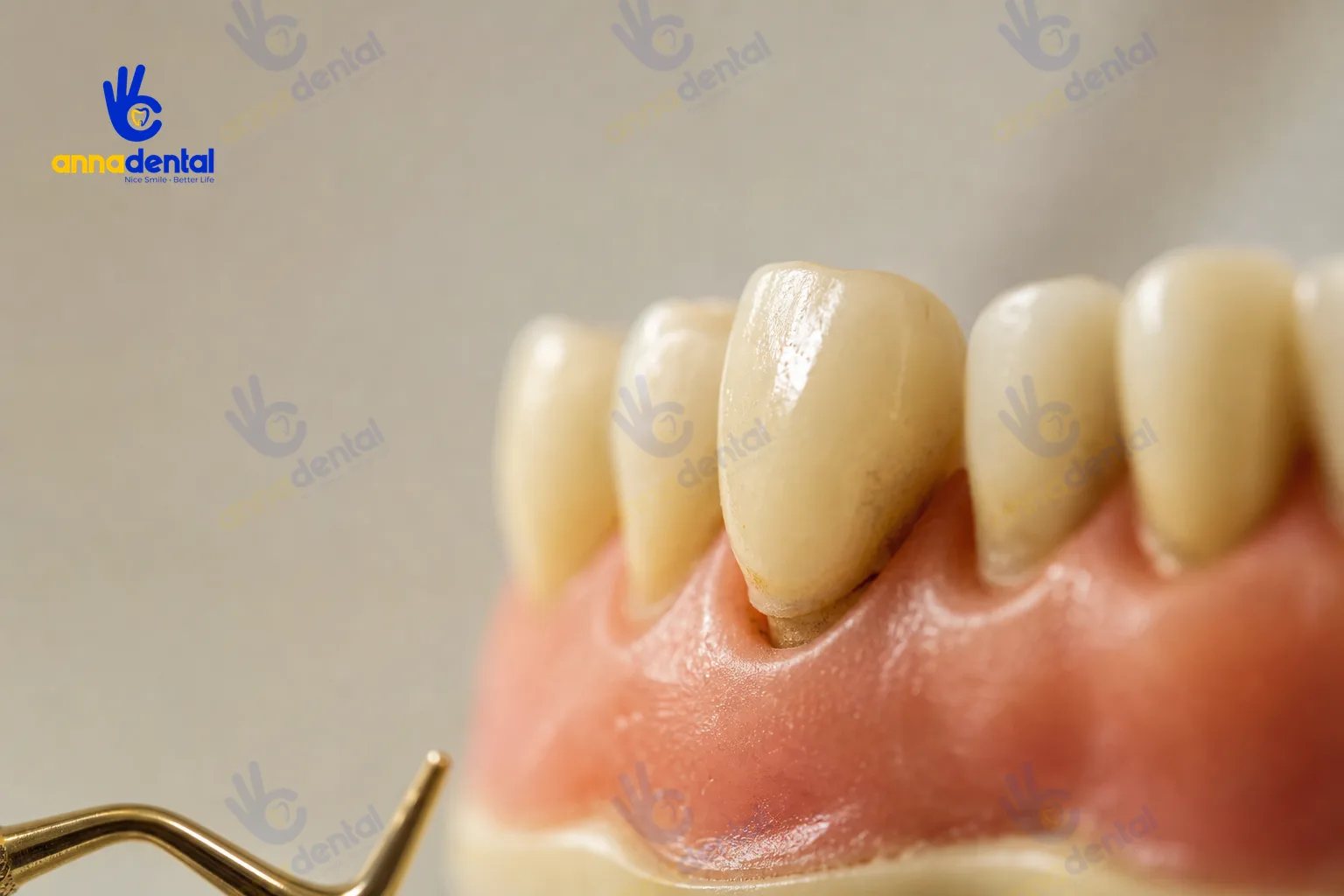 Răng lung lay ở người lớn: nguyên nhân điều trị và cách giữ răng