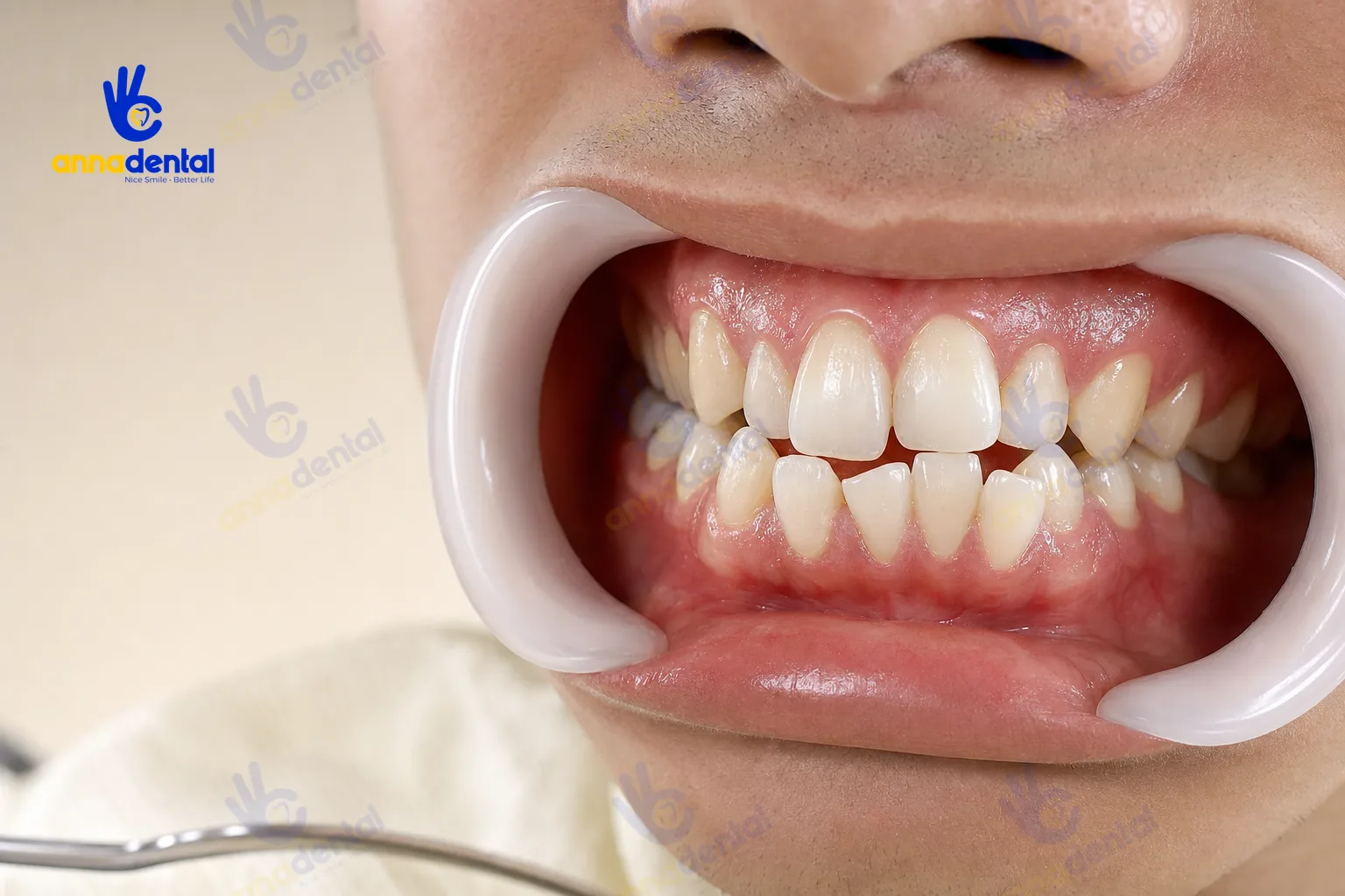 Răng mọc lệch phải làm sao hiểu đúng kiểu lệch và hướng xử lý