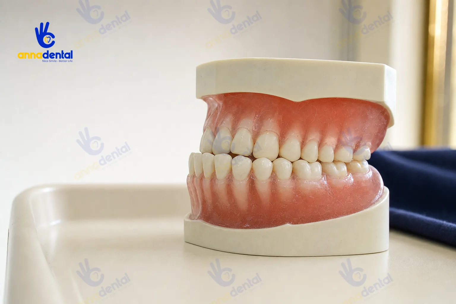 Mẫu hàm thể hiện khớp cắn ngược dạng móm rõ ràng