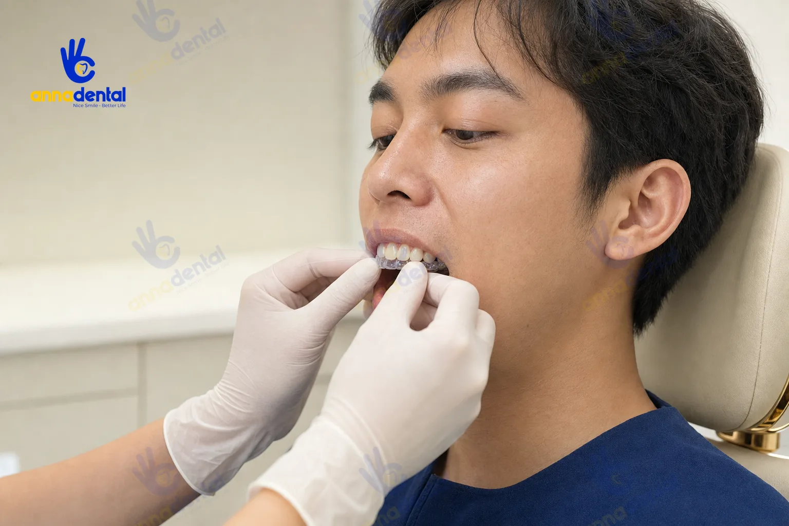 Điều chỉnh khay niềng trong suốt cho răng mọc lệch nhẹ