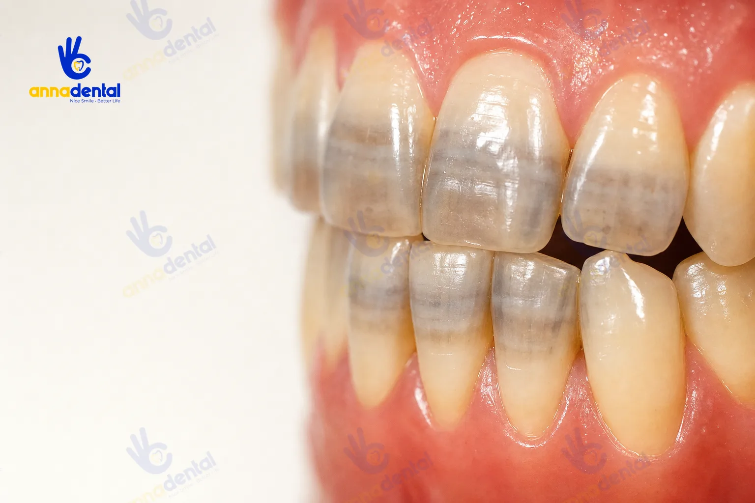 Cận cảnh răng nhiễm tetracycline với các dải xám nâu rõ rệt
