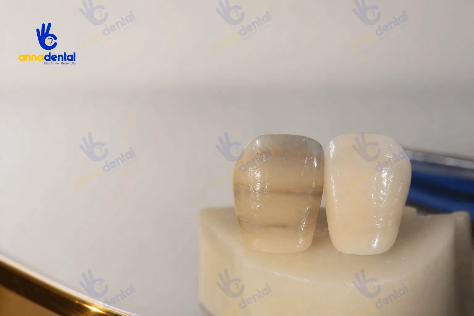 So sánh mô răng nhiễm tetracycline trước và sau tẩy trắng