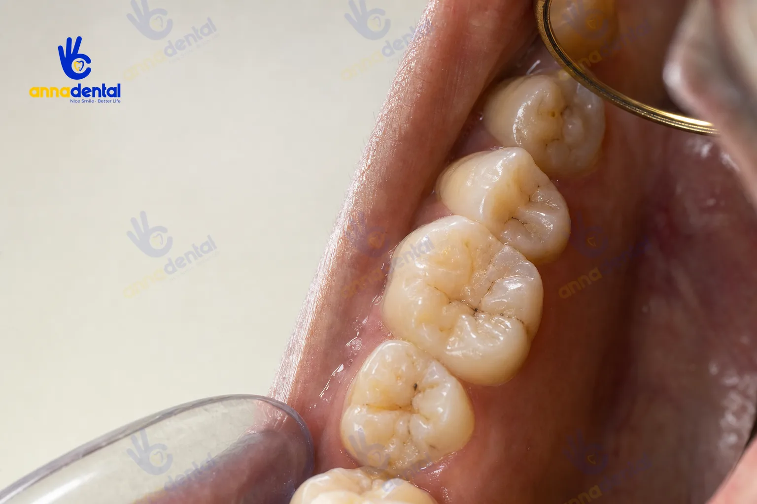 Cận cảnh trong miệng minh họa vị trí và hình dạng răng số 7