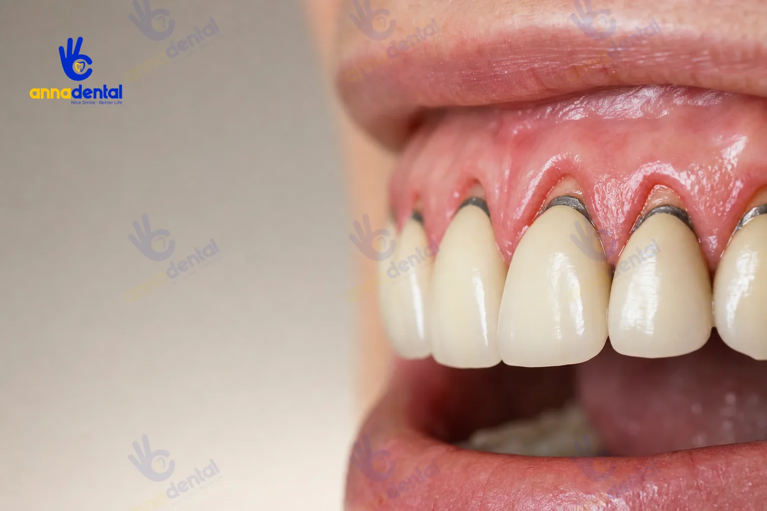 Cận cảnh răng sứ bị tụt lợi, đen viền nướu vùng răng cửa