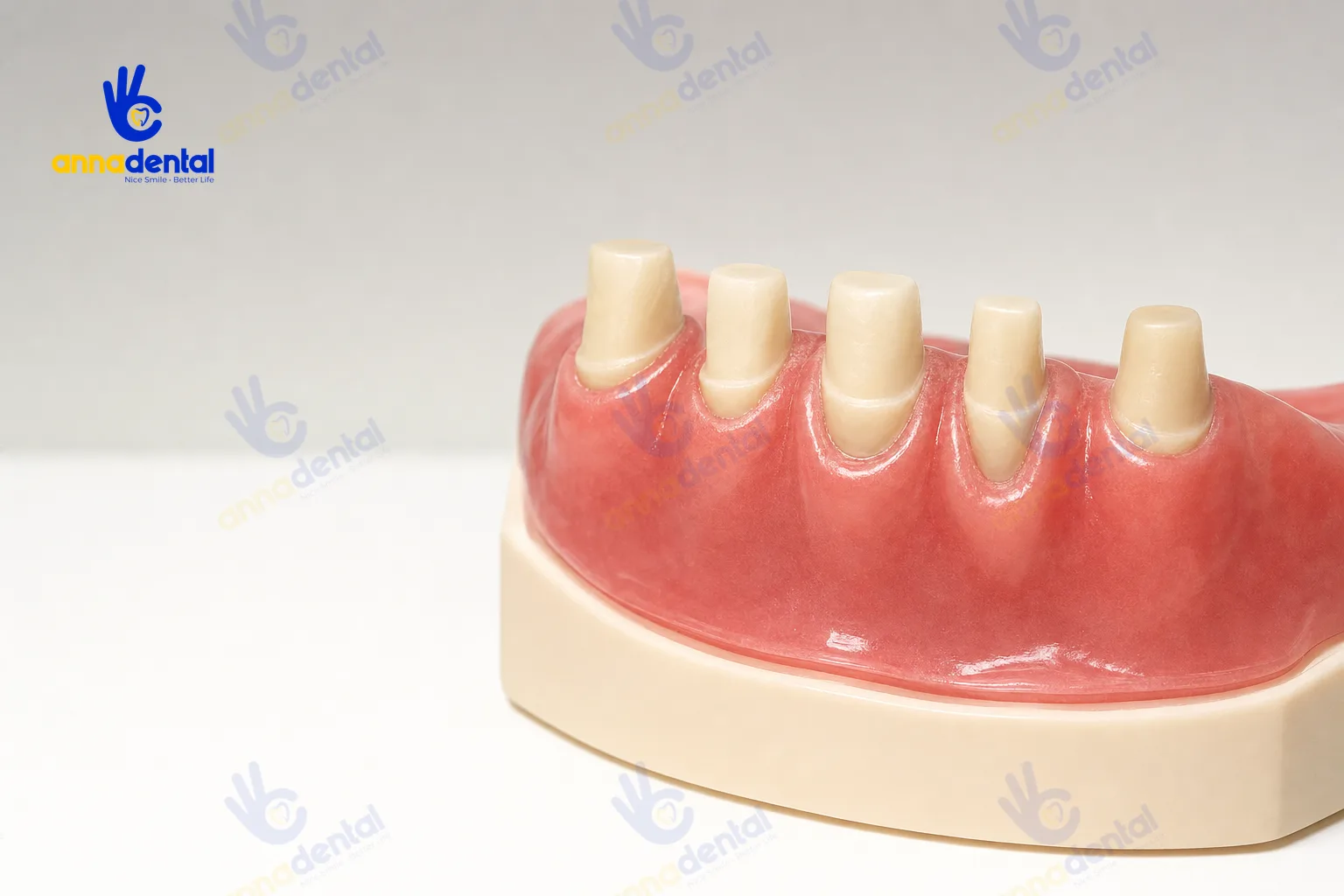 Mô hình mẫu hàm minh họa các mức độ tụt lợi quanh răng sứ
