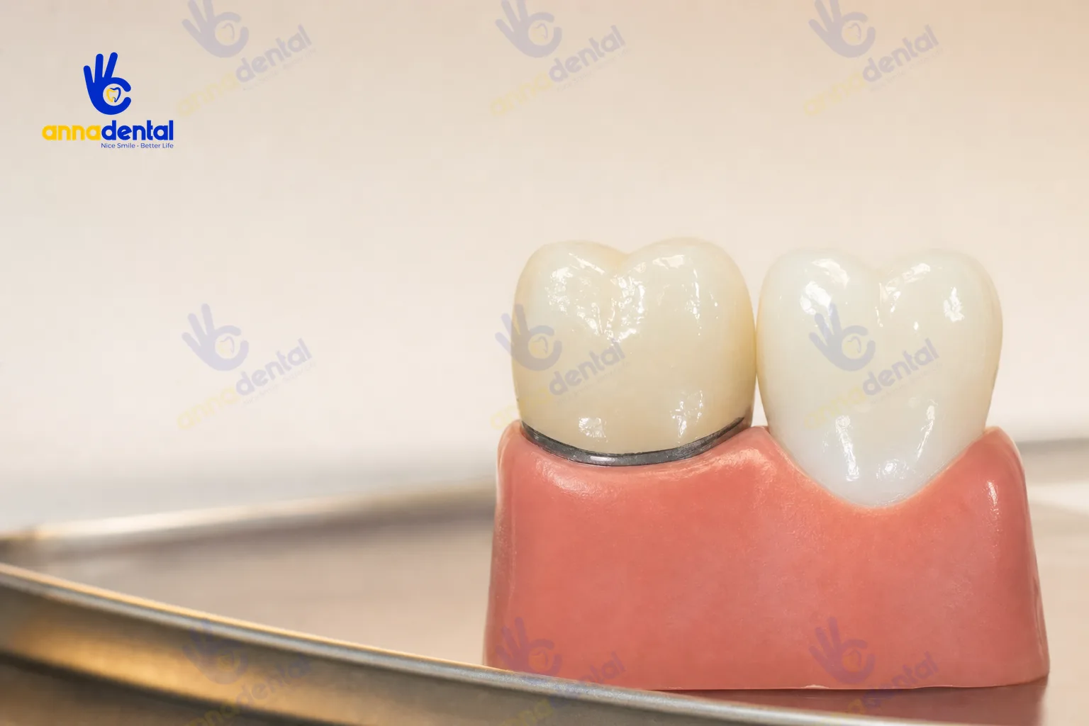 So sánh răng sứ kim loại và răng toàn sứ ở viền nướu