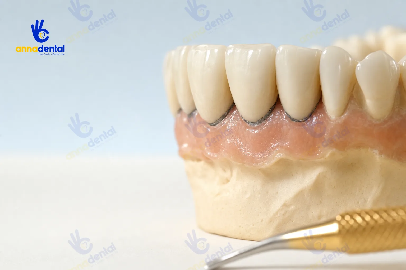 Mẫu hàm thể hiện viền nướu bị đen quanh mão sứ kim loại