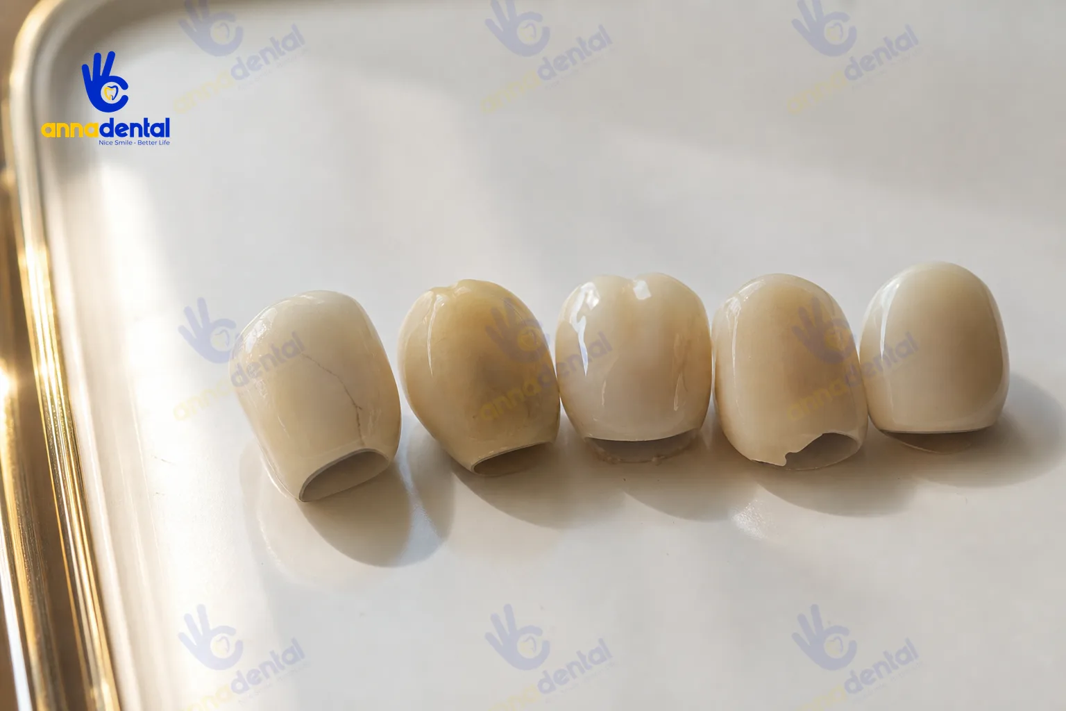 Năm mão răng sứ thật với các biểu hiện nứt, mẻ, xỉn màu khác nhau