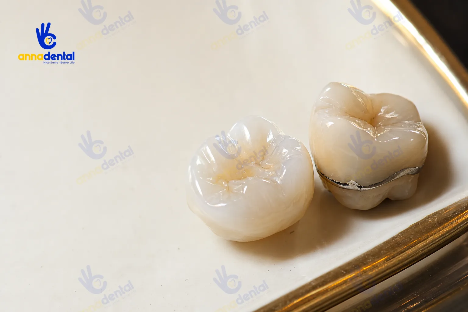 Hai mão sứ thật, một lộ viền kim loại do mài quá giới hạn