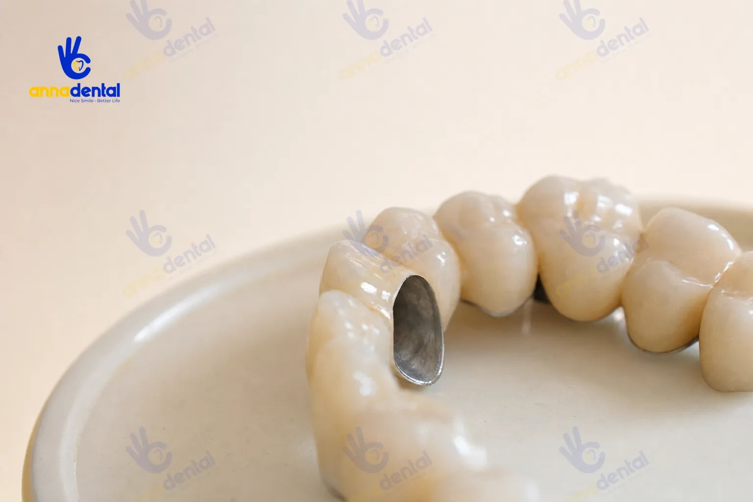 Cận cảnh mão răng sứ titan để minh họa răng sứ titan có tốt không