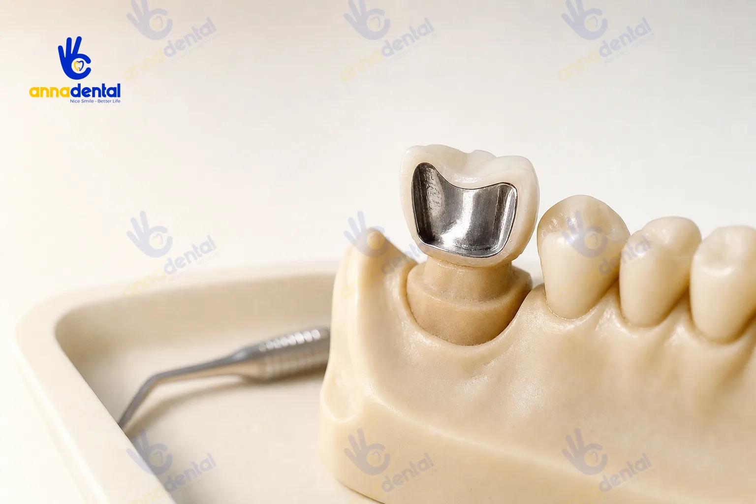 Mô hình răng thể hiện cấu tạo răng sứ titan hai lớp