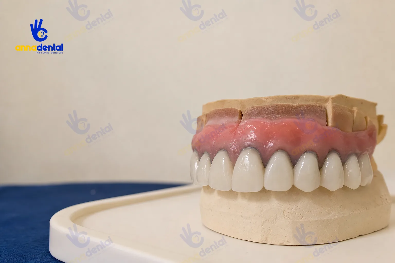 Mô hình răng minh họa nguy cơ đen viền nướu của răng sứ titan