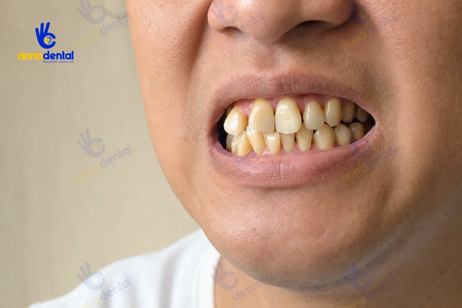 Cận cảnh hàm răng xấu với răng khấp khểnh và xỉn màu