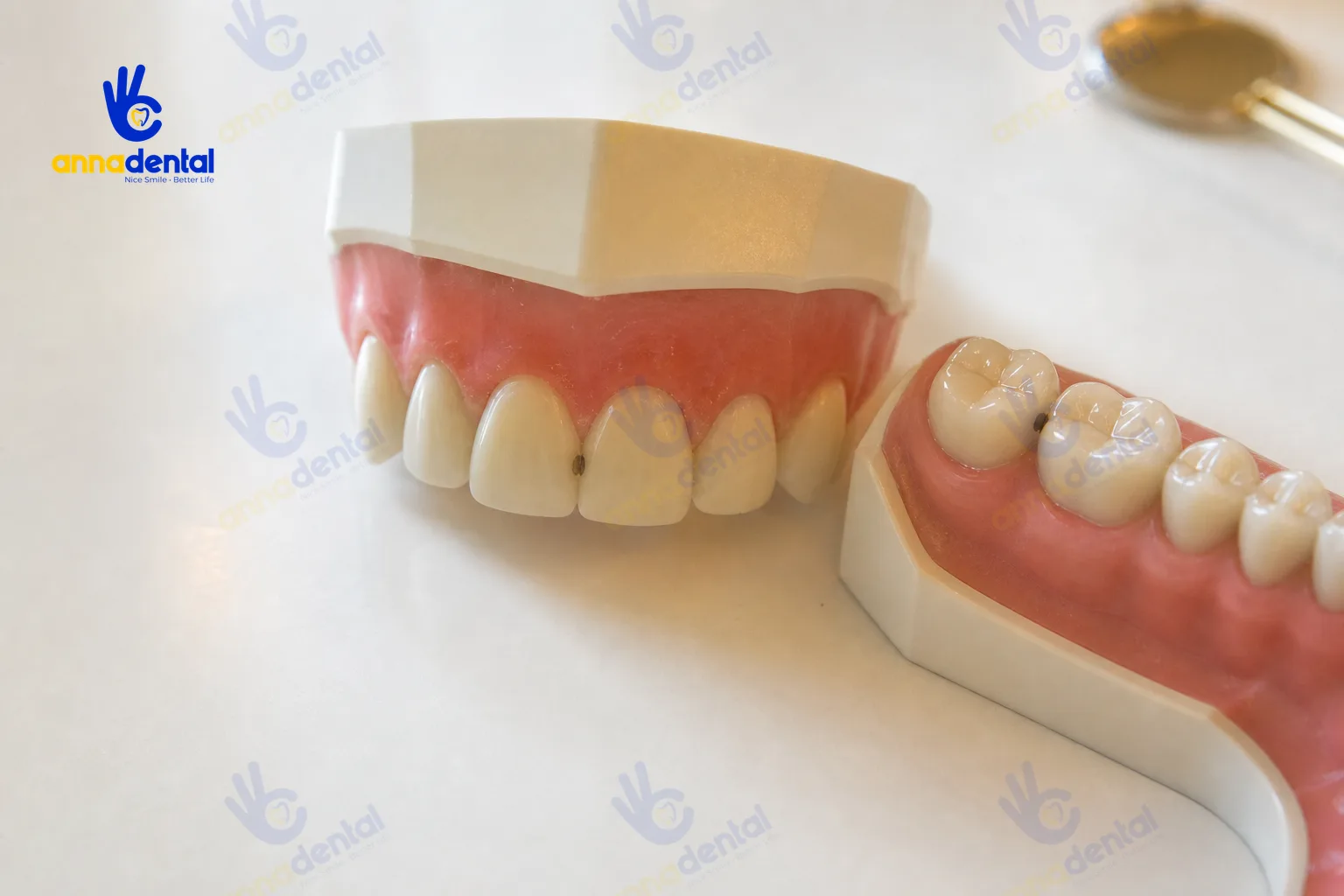 Ảnh so sánh vị trí sâu kẽ răng ở răng cửa và răng hàm