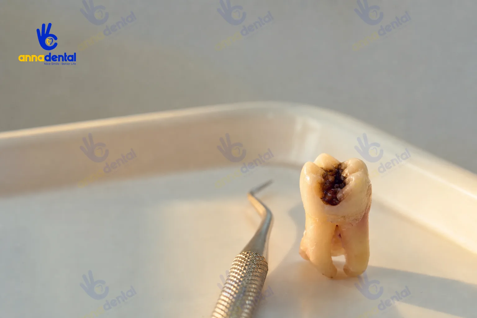 Sâu răng: dấu hiệu nhận biết và cách điều trị hiệu quả từng giai đoạn