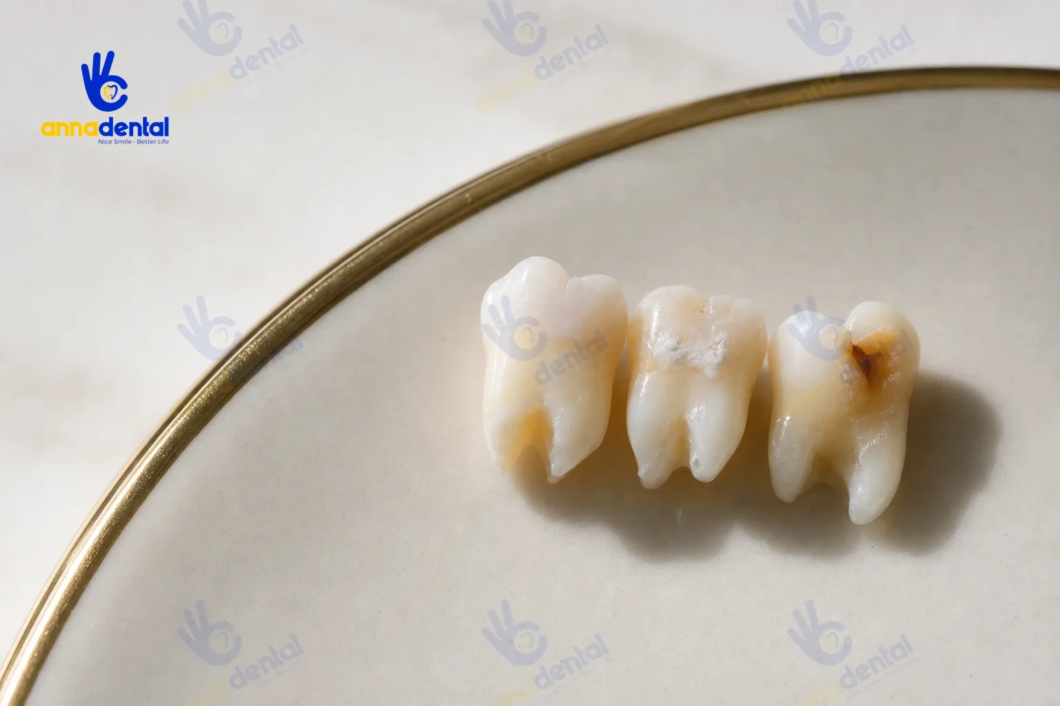 Các mẫu răng sữa thật với dấu hiệu sâu từ nhỏ đến lỗ sâu