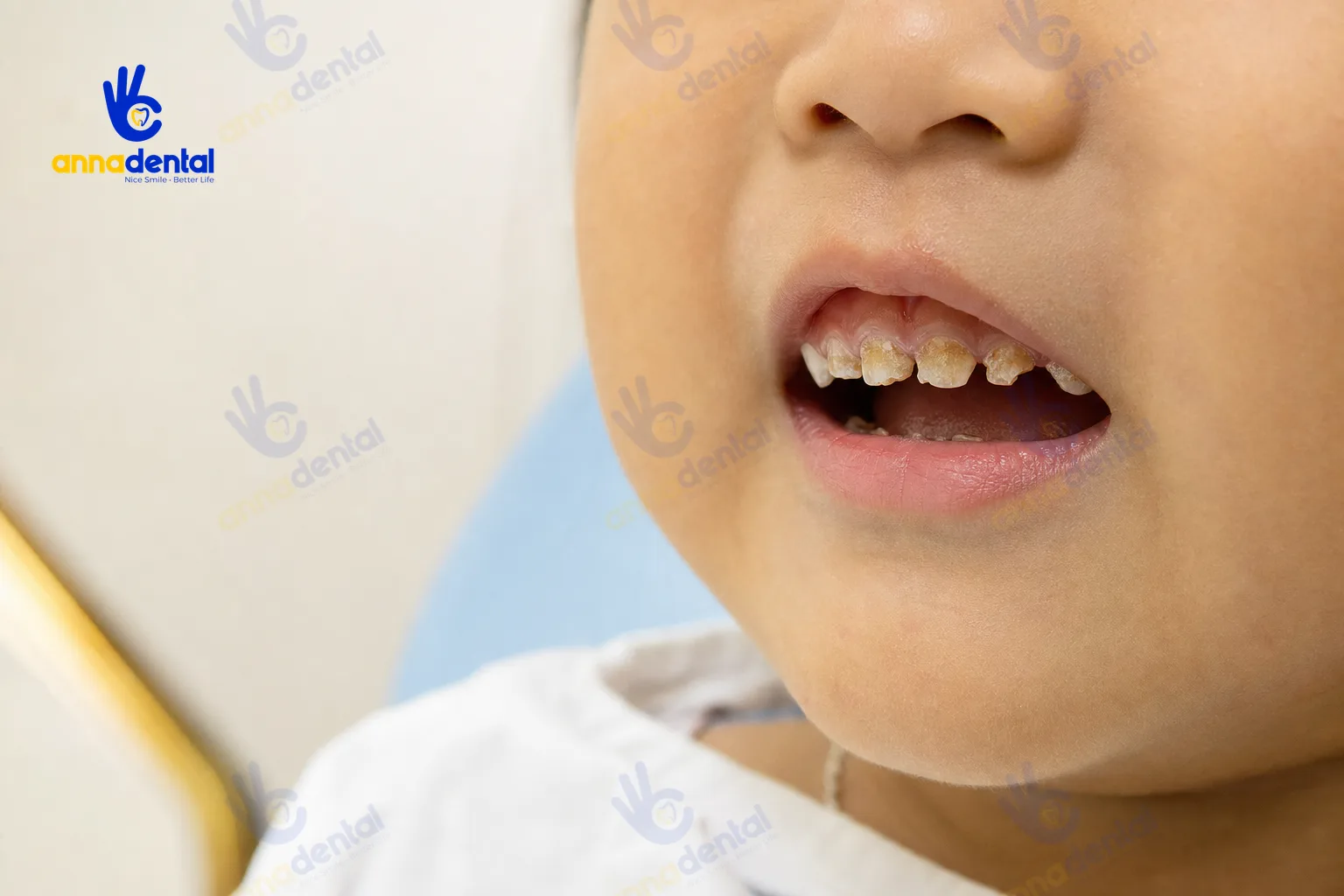Cận cảnh sún răng ở răng cửa sữa của trẻ nhỏ