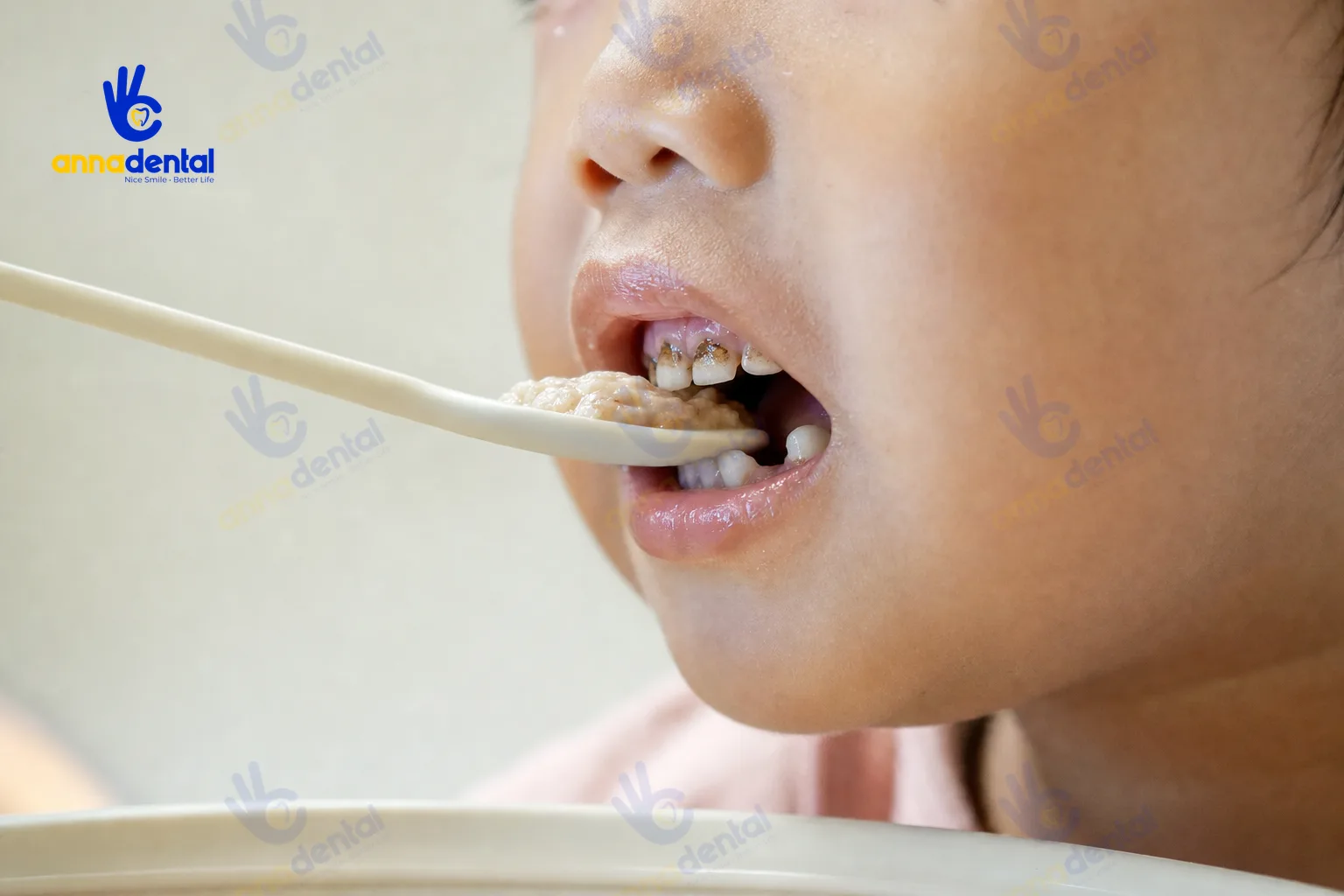 Trẻ ăn uống khó khăn do răng cửa sữa bị sún răng