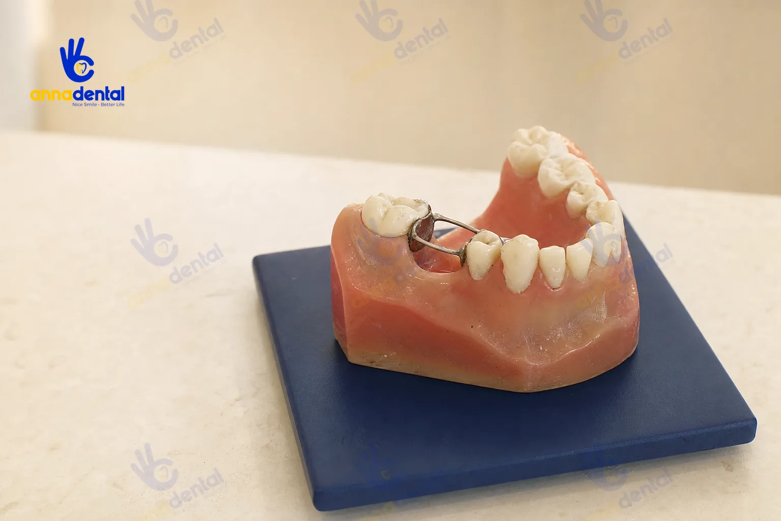 Mô hình răng có khí cụ giữ khoảng sau mất răng sữa
