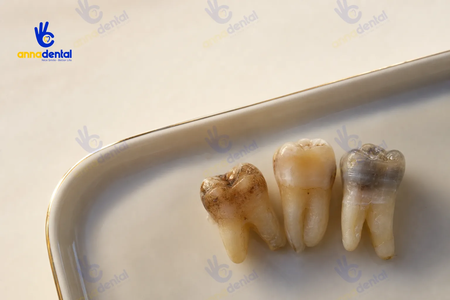 Ba mẫu răng với mức độ ố vàng và nhiễm màu khác nhau trên khay trắng trơn