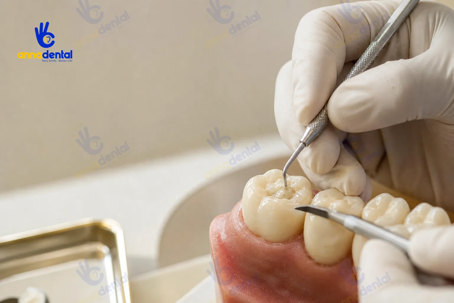 Trám răng có đau không? Giải đáp từ bác sĩ và cảm giác thực tế