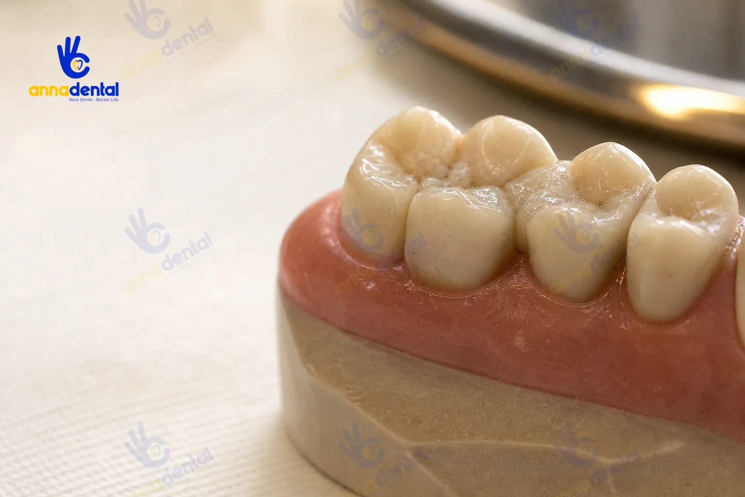 Hình cận cảnh vị trí miếng trám hơi cao gây cảm giác ê buốt sau khi trám răng