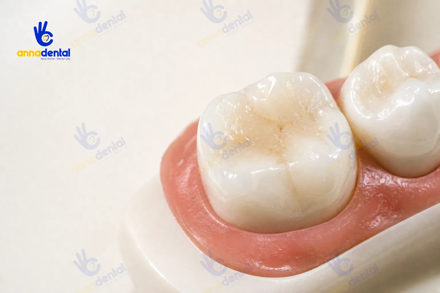 Cận cảnh răng đã trám răng xong với chất liệu composite tự nhiên