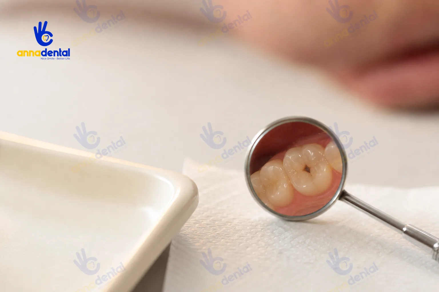Hình ảnh lỗ sâu nhỏ trên răng được soi bằng gương khám nha khoa
