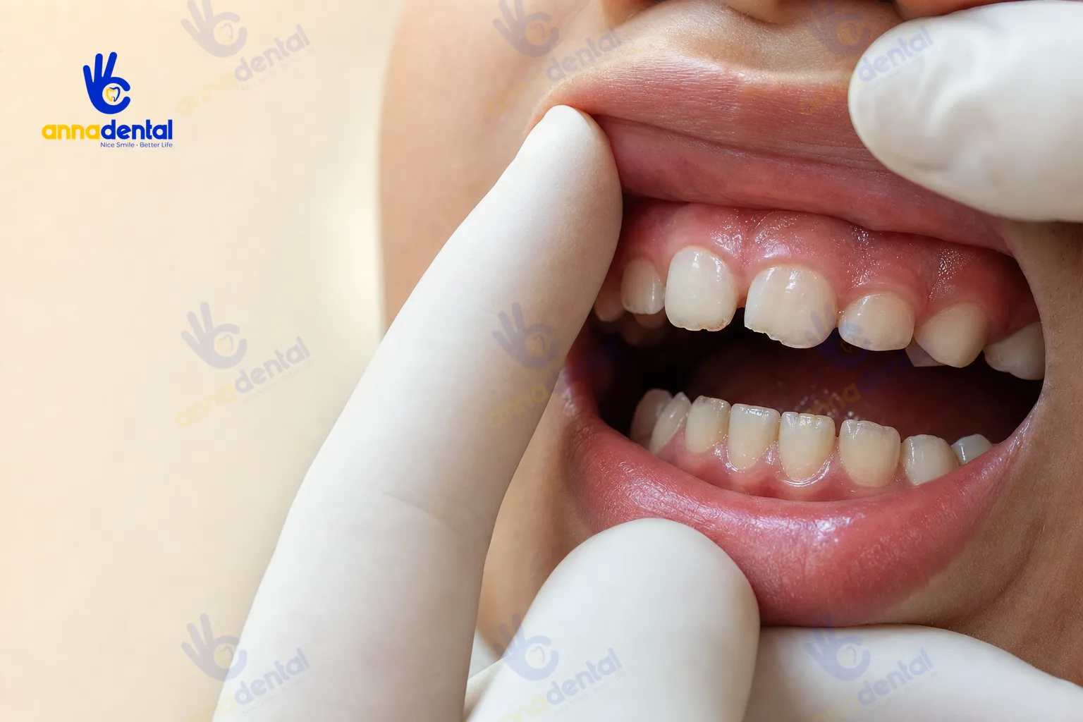 Cận cảnh răng trẻ em có dấu hiệu mòn nhẹ do nghiến
