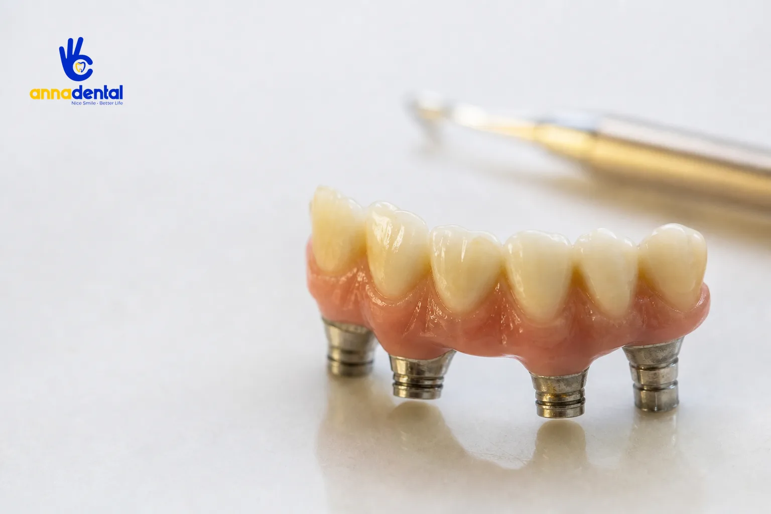 Hình ảnh trồng răng implant all on 4 gồm cầu răng gắn trên bốn trụ