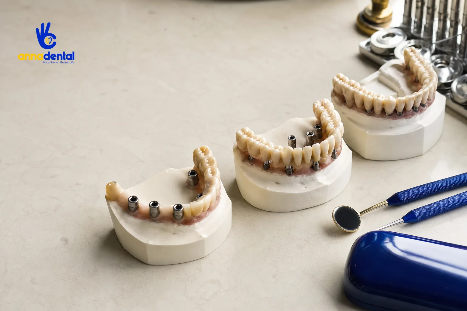 Ba mẫu hàm với các phương pháp All-on-4, All-on-6 và Implant đơn lẻ