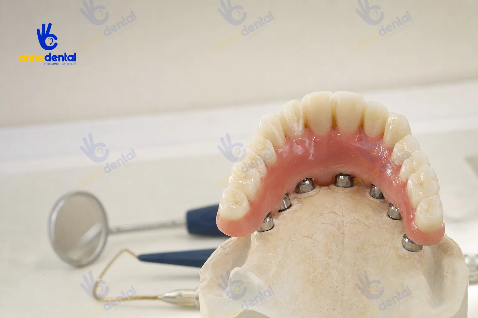 Mô hình trồng răng Implant All-on-6 toàn hàm trên xương hàm