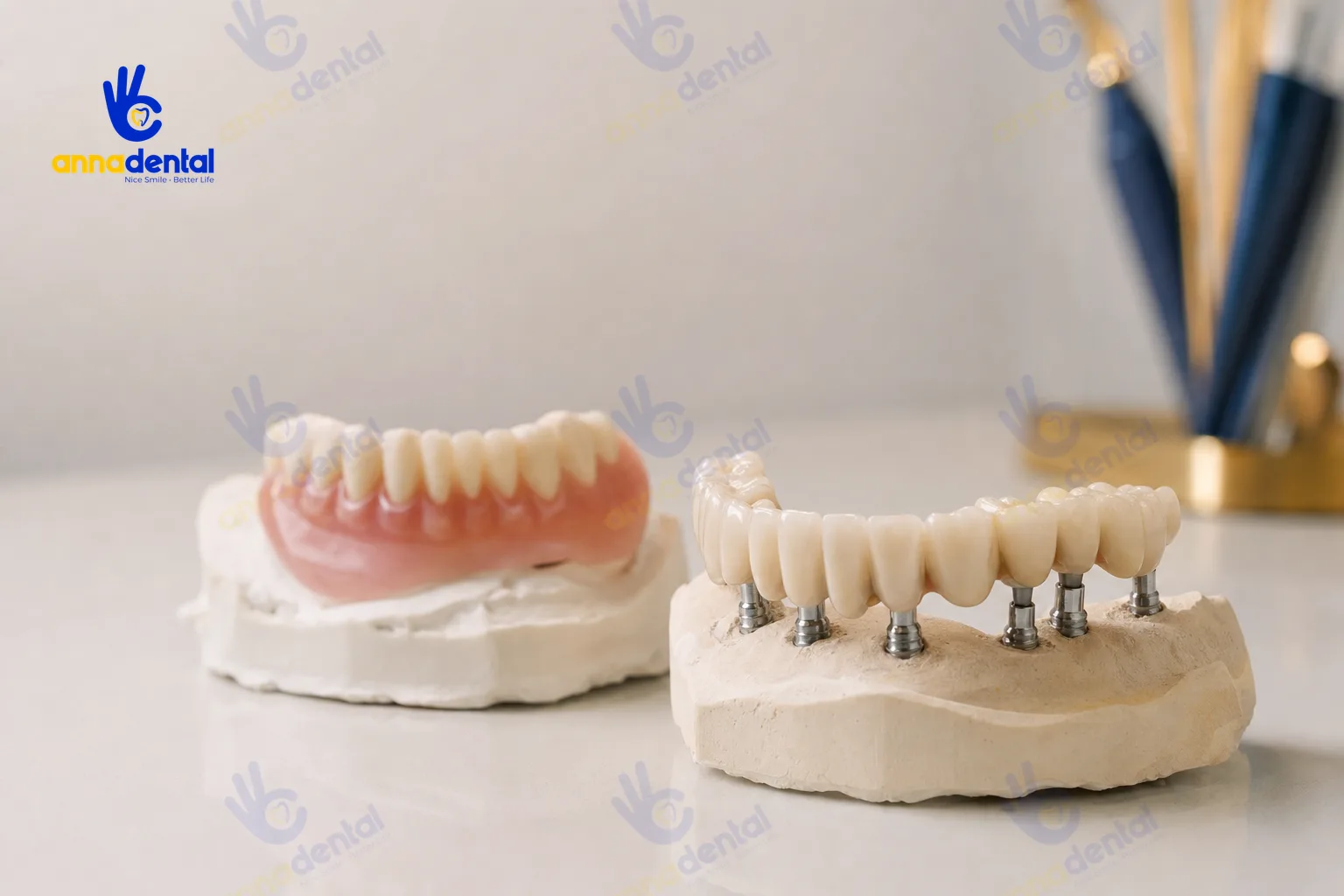 So sánh hàm tháo lắp và phục hình cố định All-on-6