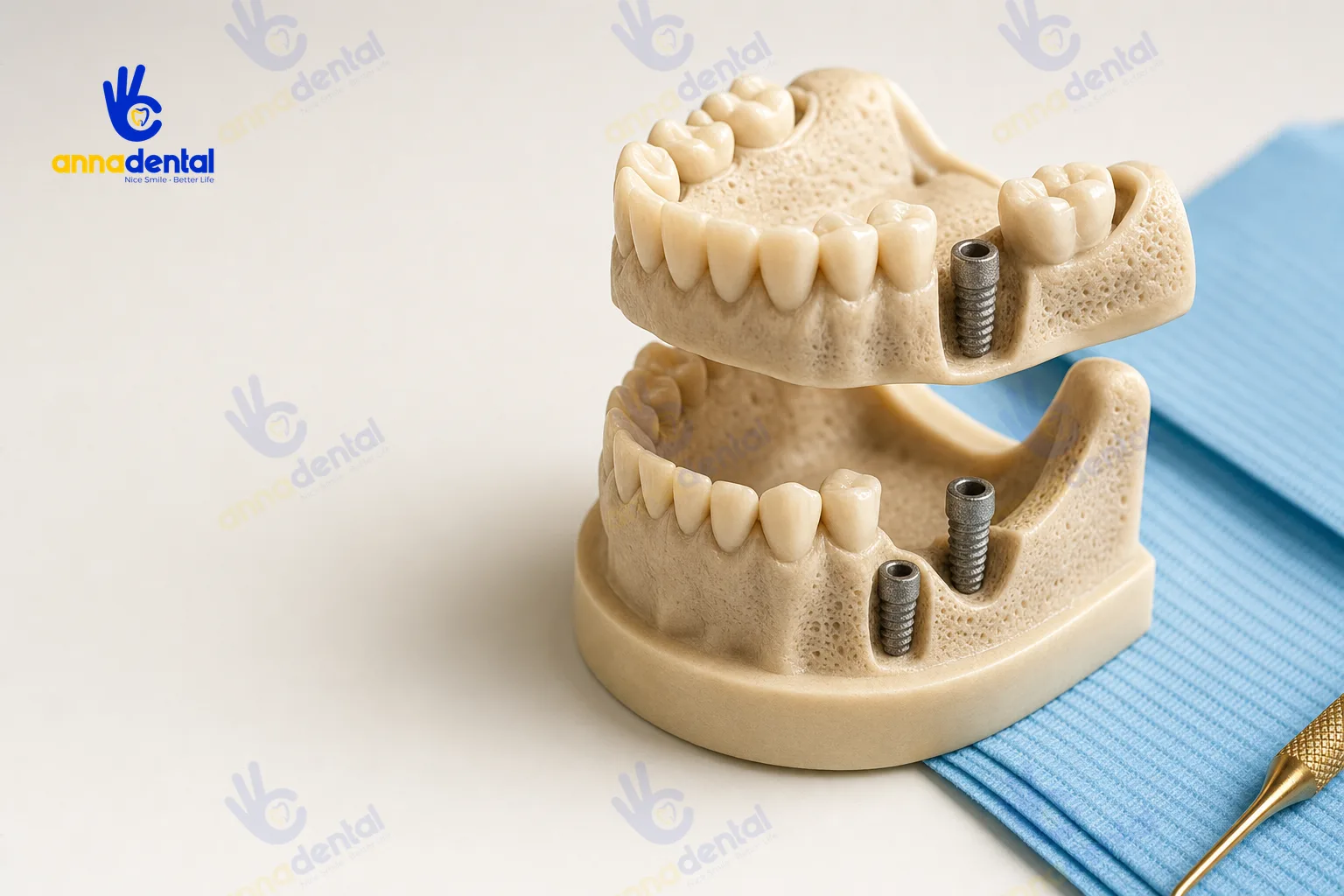 Mô hình hàm với nhiều trụ implant minh họa các vị trí cấy khác nhau