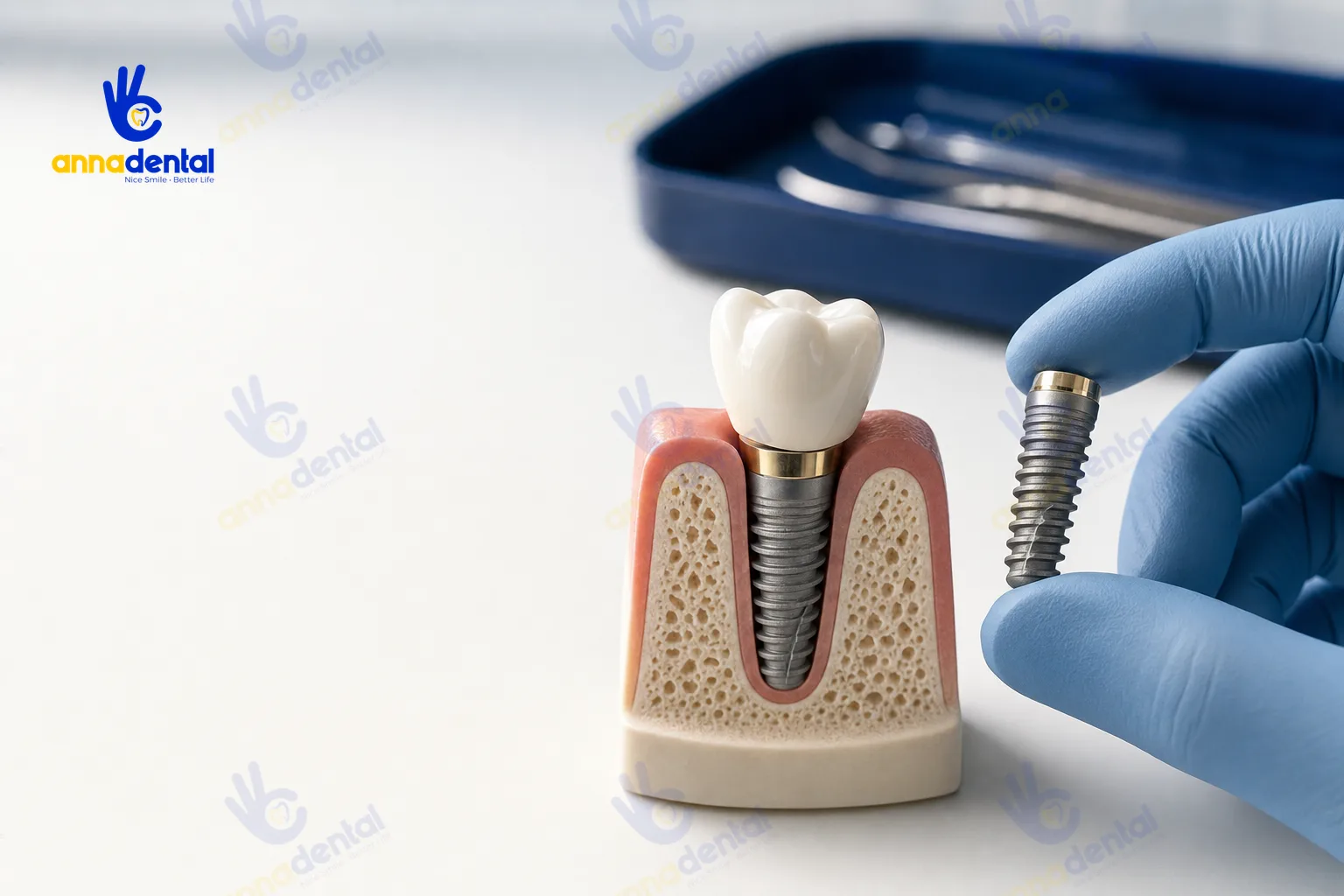 Mô hình trụ implant tích hợp trong xương hàm và mão sứ phía trên