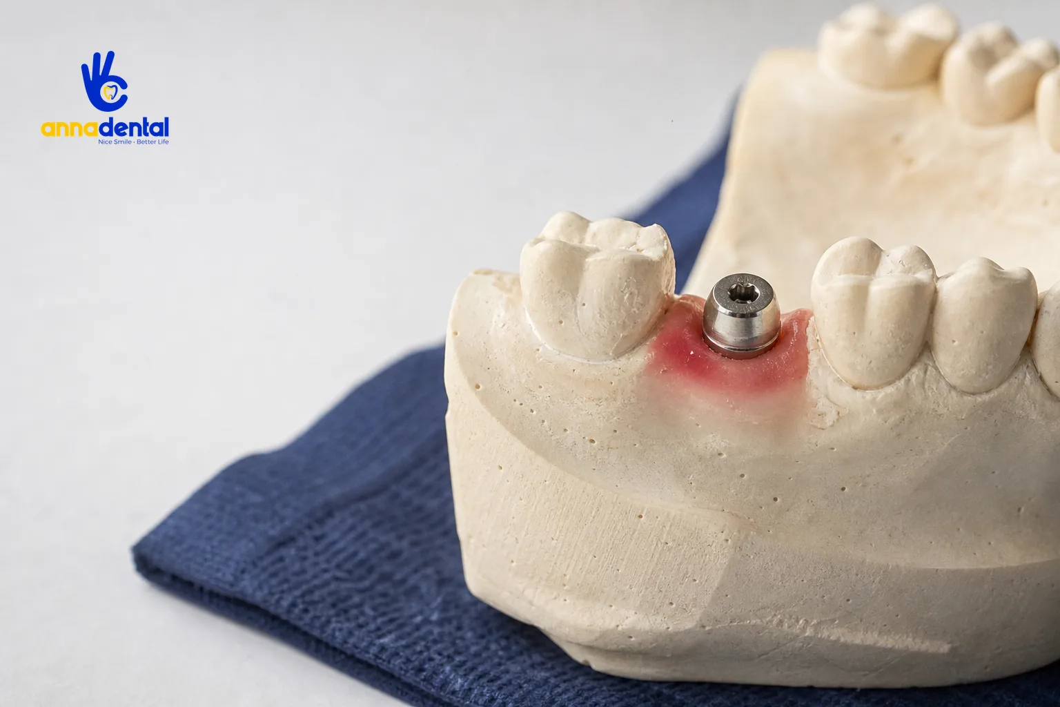 Cận cảnh mô phỏng implant với nướu hơi sưng đỏ sau khi cấy ghép