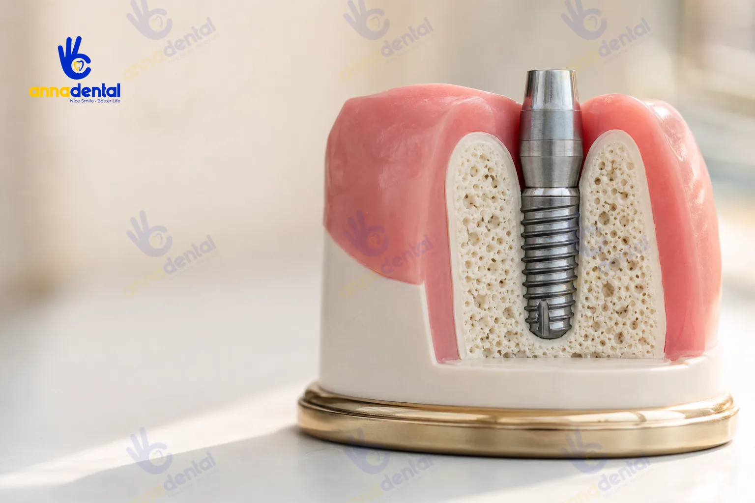 Mô phỏng cấu trúc trụ Implant trong xương hàm và mô mềm