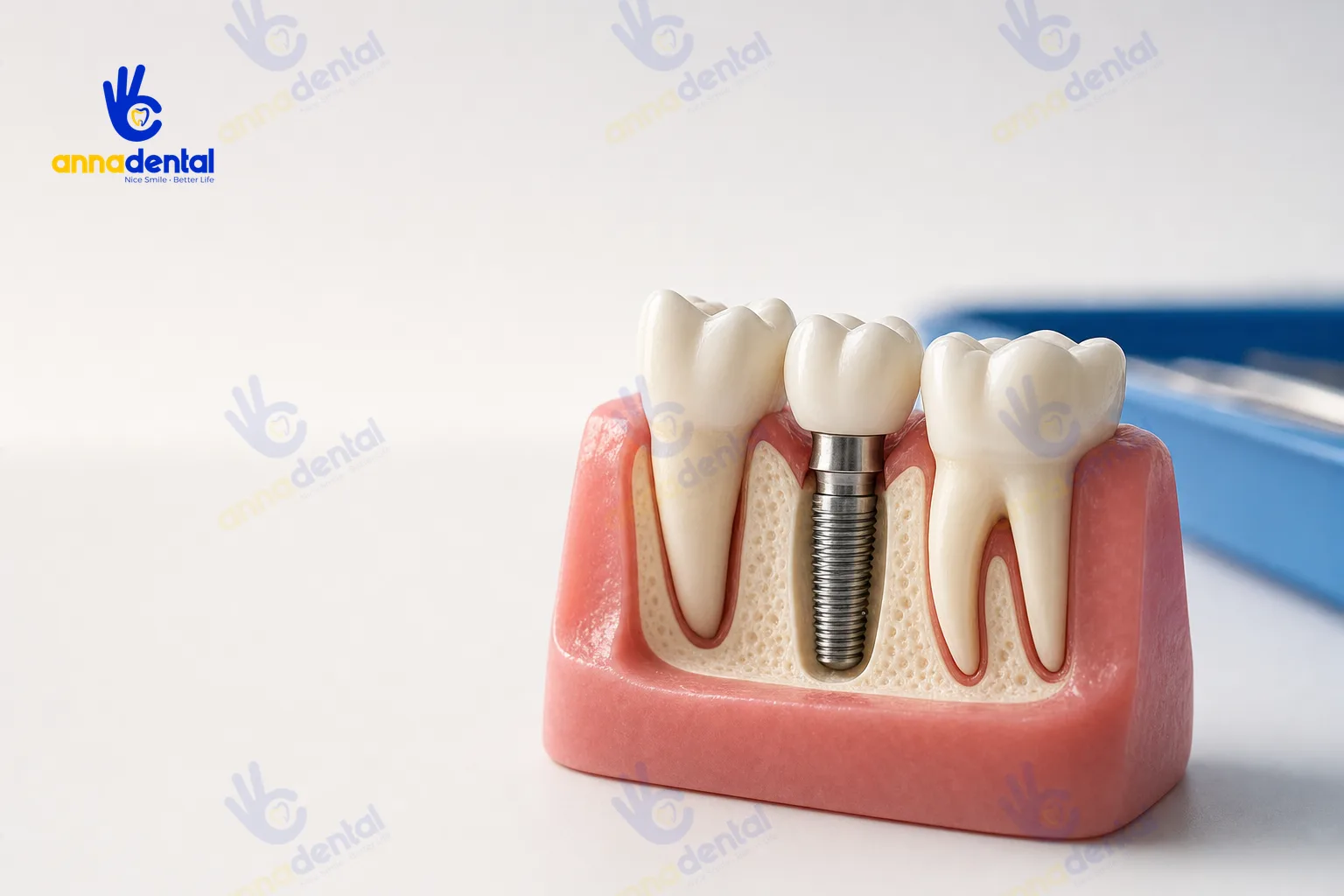 Mô hình hàm thể hiện cấu tạo trụ Implant và mão sứ