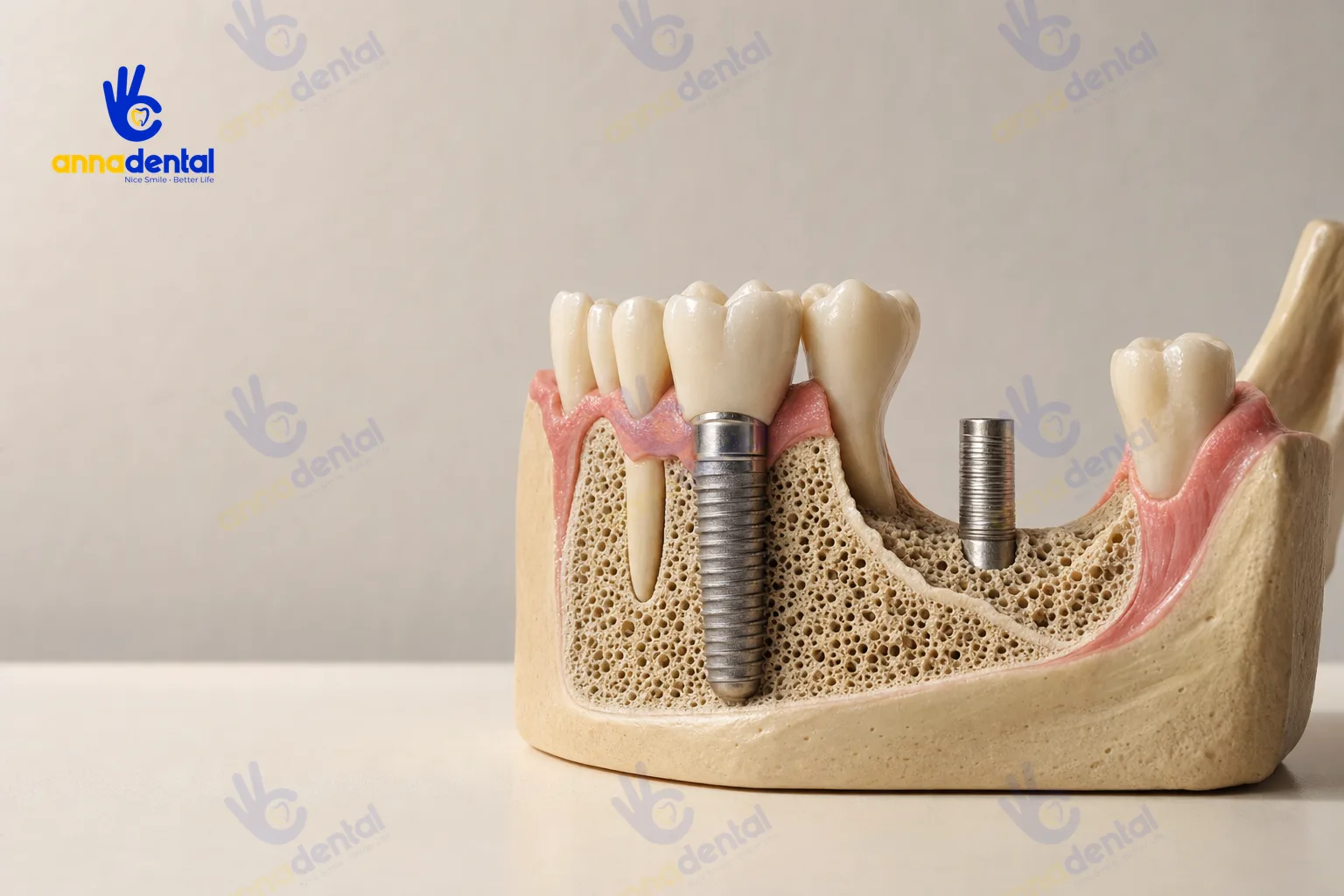 Mô hình xương hàm có trụ Implant và vùng tiêu xương cần cân nhắc