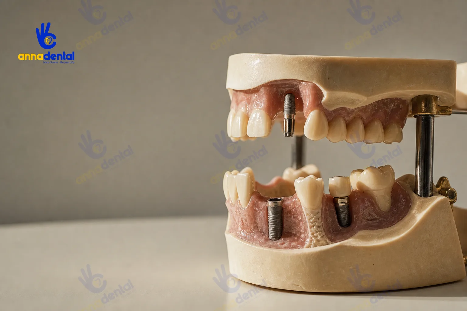 Mô hình răng giả minh hoạ ảnh hưởng vị trí đến chi phí implant