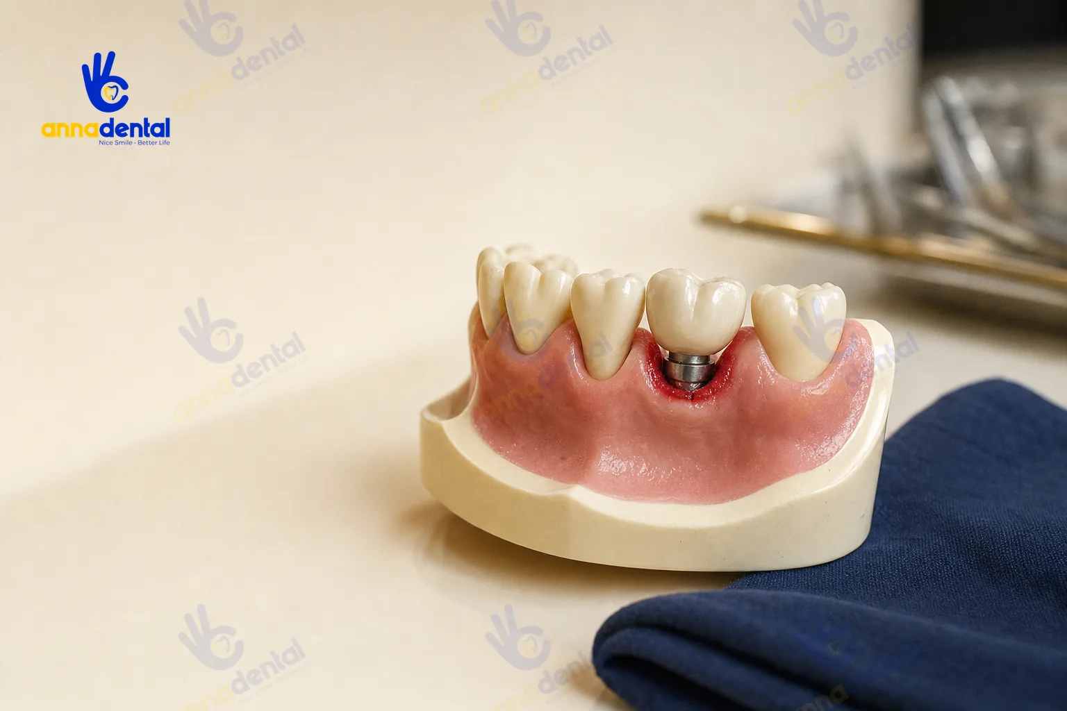 Mô hình nướu quanh răng implant có dấu hiệu viêm đỏ nhẹ