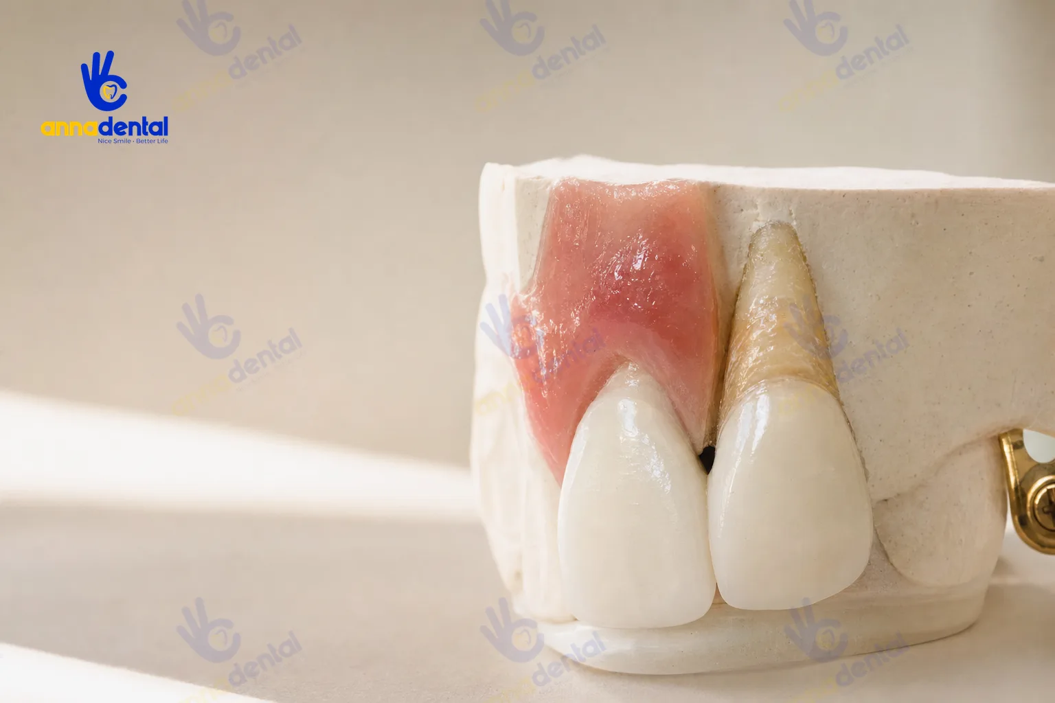 Mẫu răng cho thấy tam giác đen do tụt nhú lợi giữa hai răng