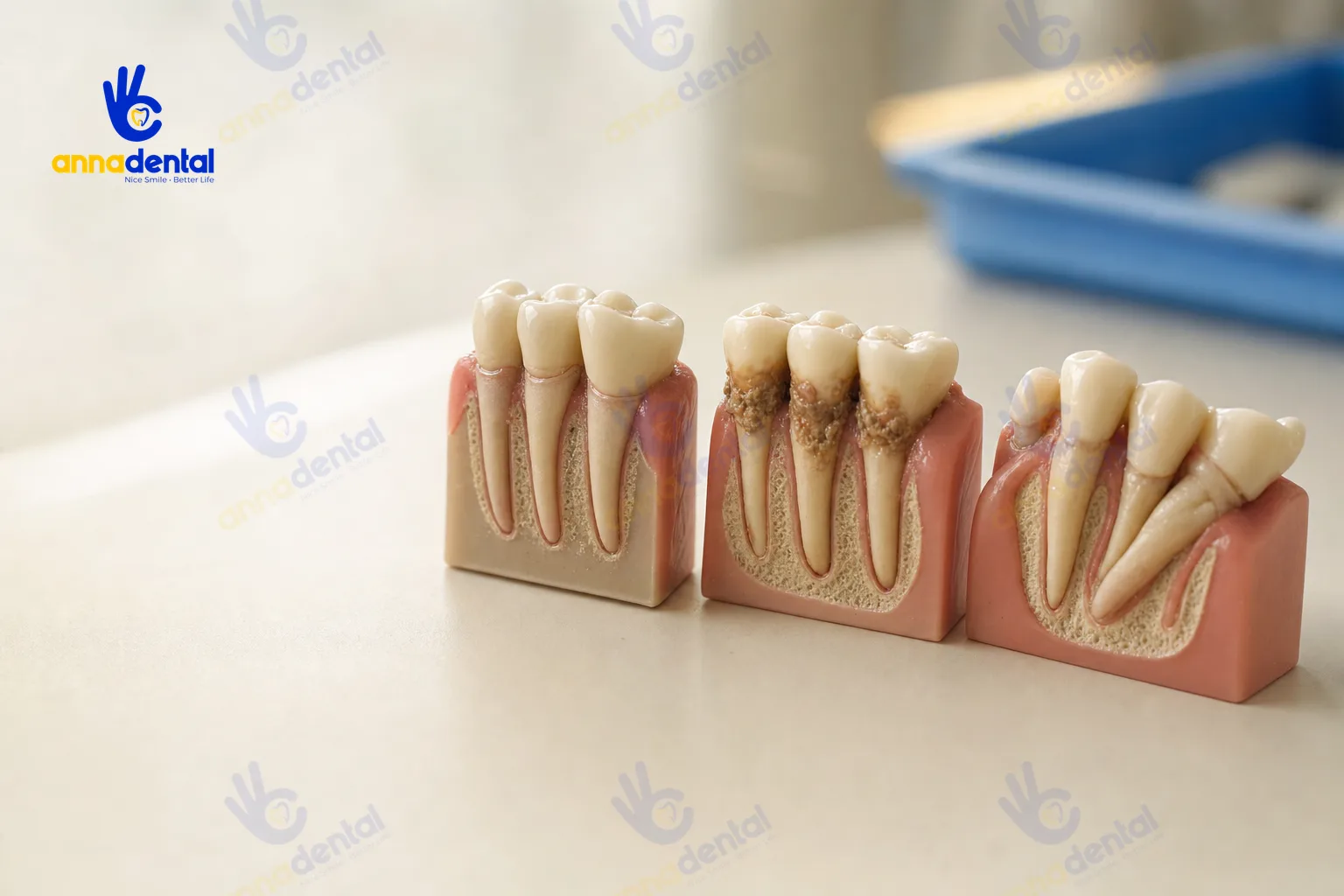 Ba mẫu răng minh họa tụt lợi cơ học và tụt lợi do nha chu