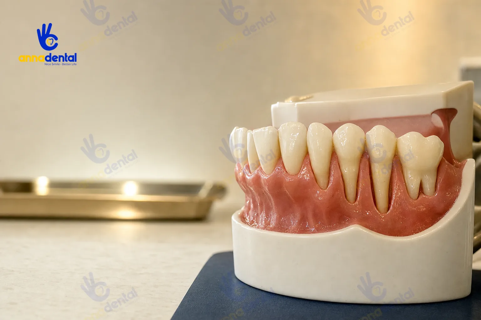 Mẫu răng minh họa các mức độ tụt lợi từ nhẹ đến nặng