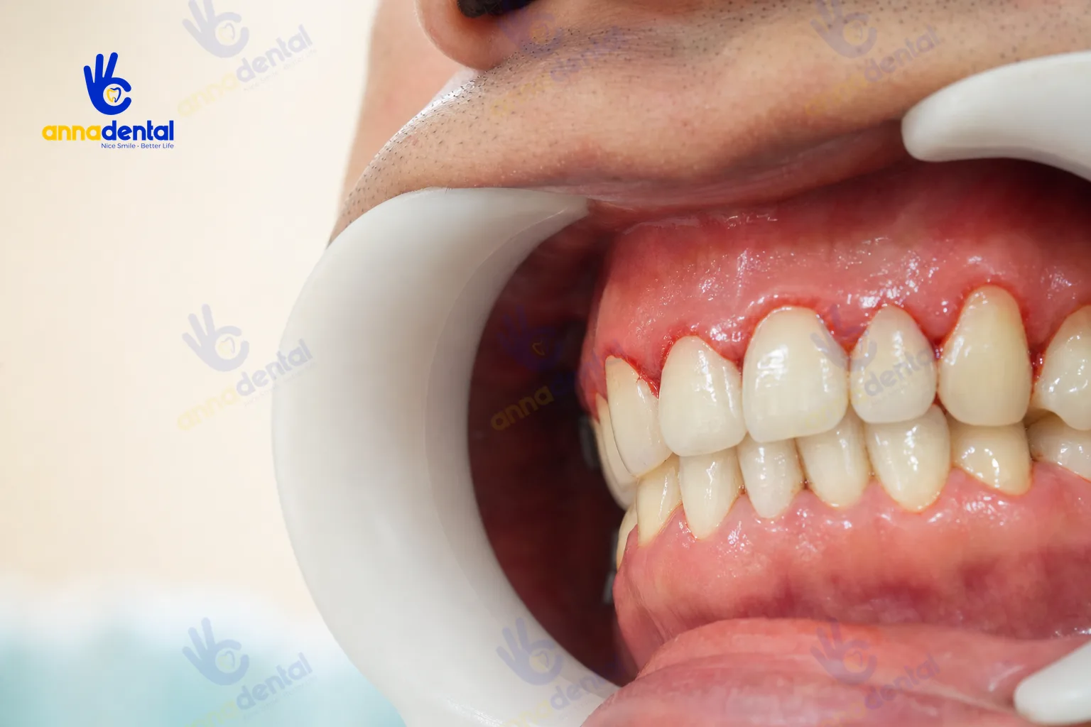 Cận cảnh nướu răng bị viêm lợi sưng đỏ nhẹ quanh răng cửa