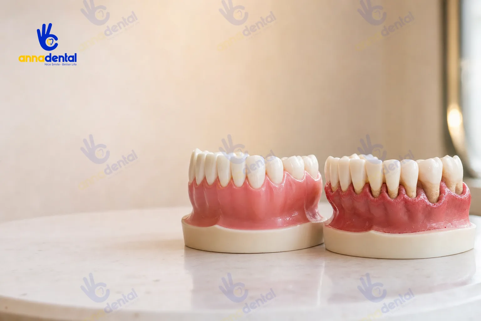 Mẫu hàm so sánh nướu khỏe mạnh và nướu viêm nha chu