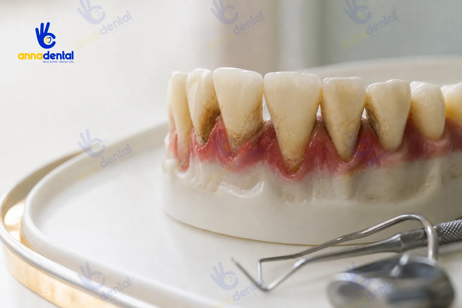 Viêm nha chu là gì: dấu hiệu nhận biết, nguyên nhân và hướng xử lý