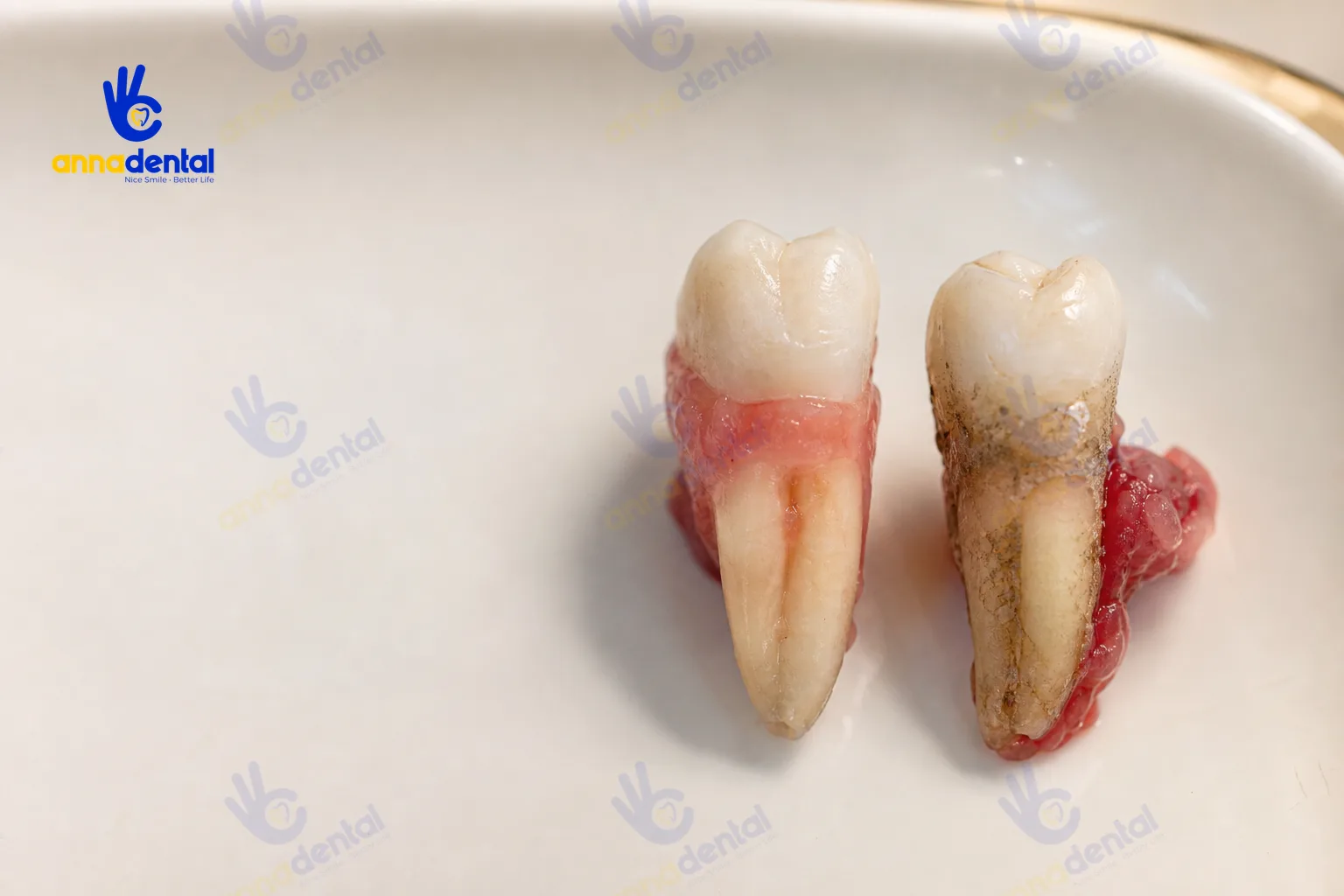 So sánh răng thật bị viêm nha chu với răng nướu khỏe mạnh trên khay trơn